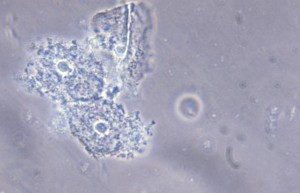 microscope view of bacterial vaginosis