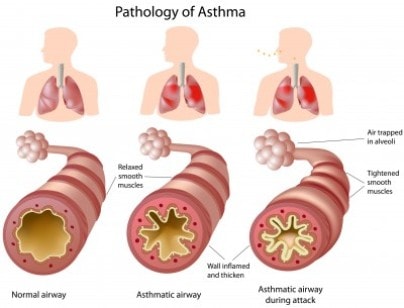 Asthma Natural Remedies: asthma pathology