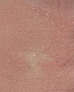 Summer skin diseases: Dry skin