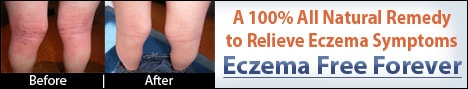 eczema-free