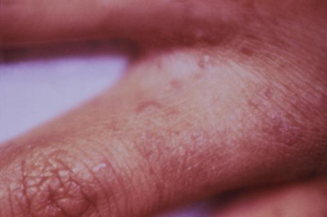 Scabies Natural Remedies