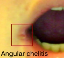 angular chelitis