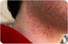 Folliculitis