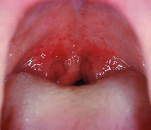 Sore throat is also termed as pharyngitis or tonsillitis