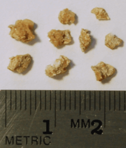 Kidney stone fragments of 1cm kidney stone