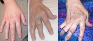 Rheumatoid arthritis