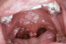 mouth candidiasis