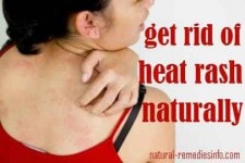 heat rash remedies