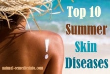 Summer skin diseases