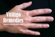 Vitiligo remedies | natural-remediesinfo.com